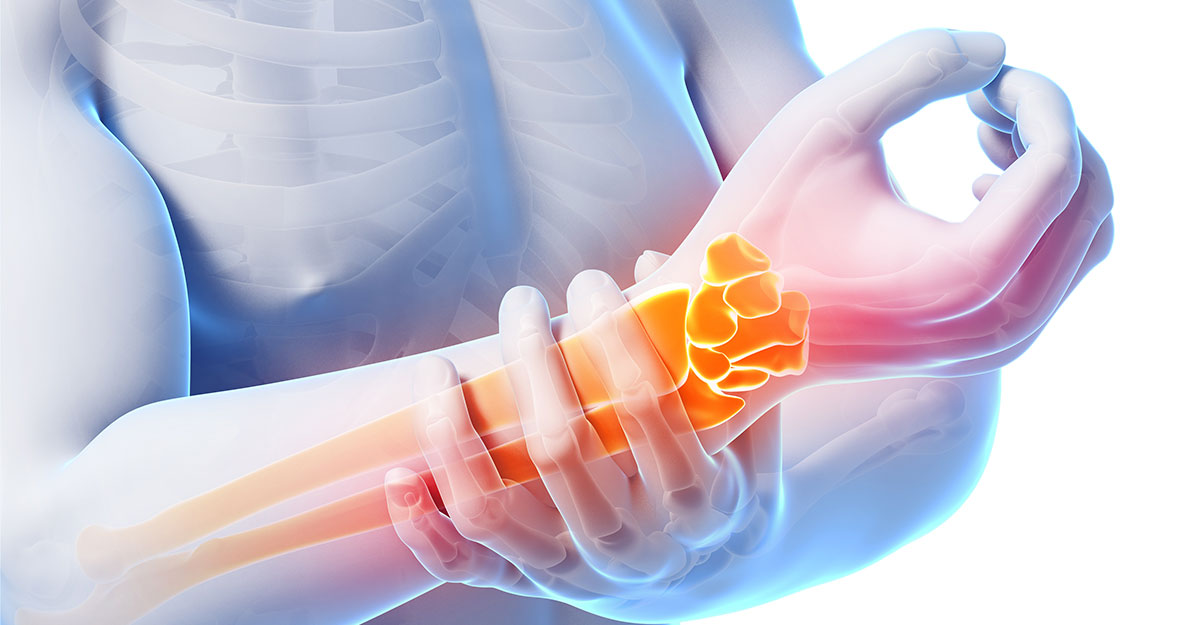Featured image for Natural Carpal Tunnel Treatment with Chiropractic